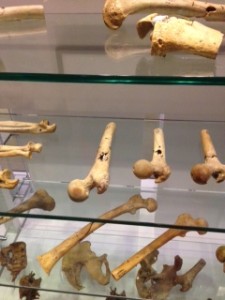 diseased bones at the museum